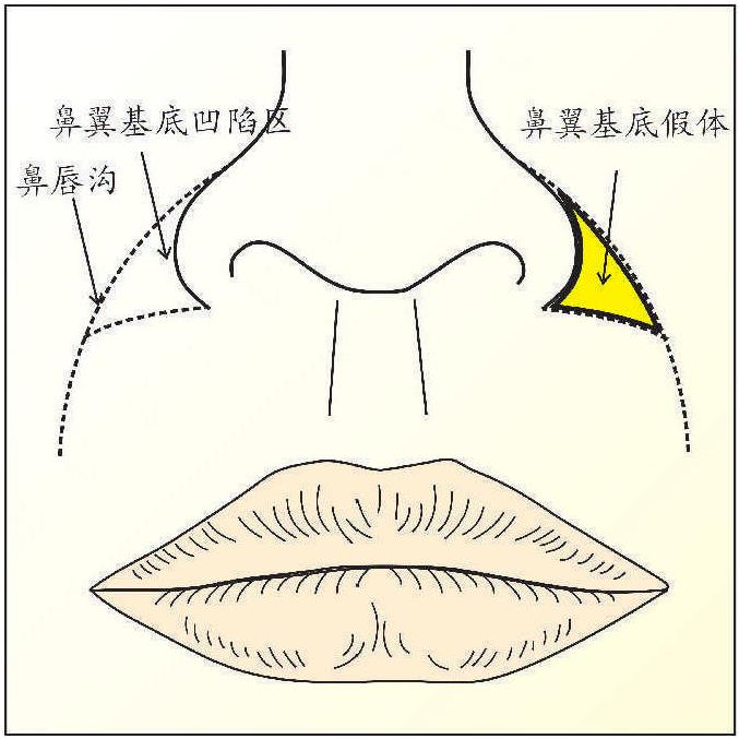 手術(shù)設(shè)計(jì)
